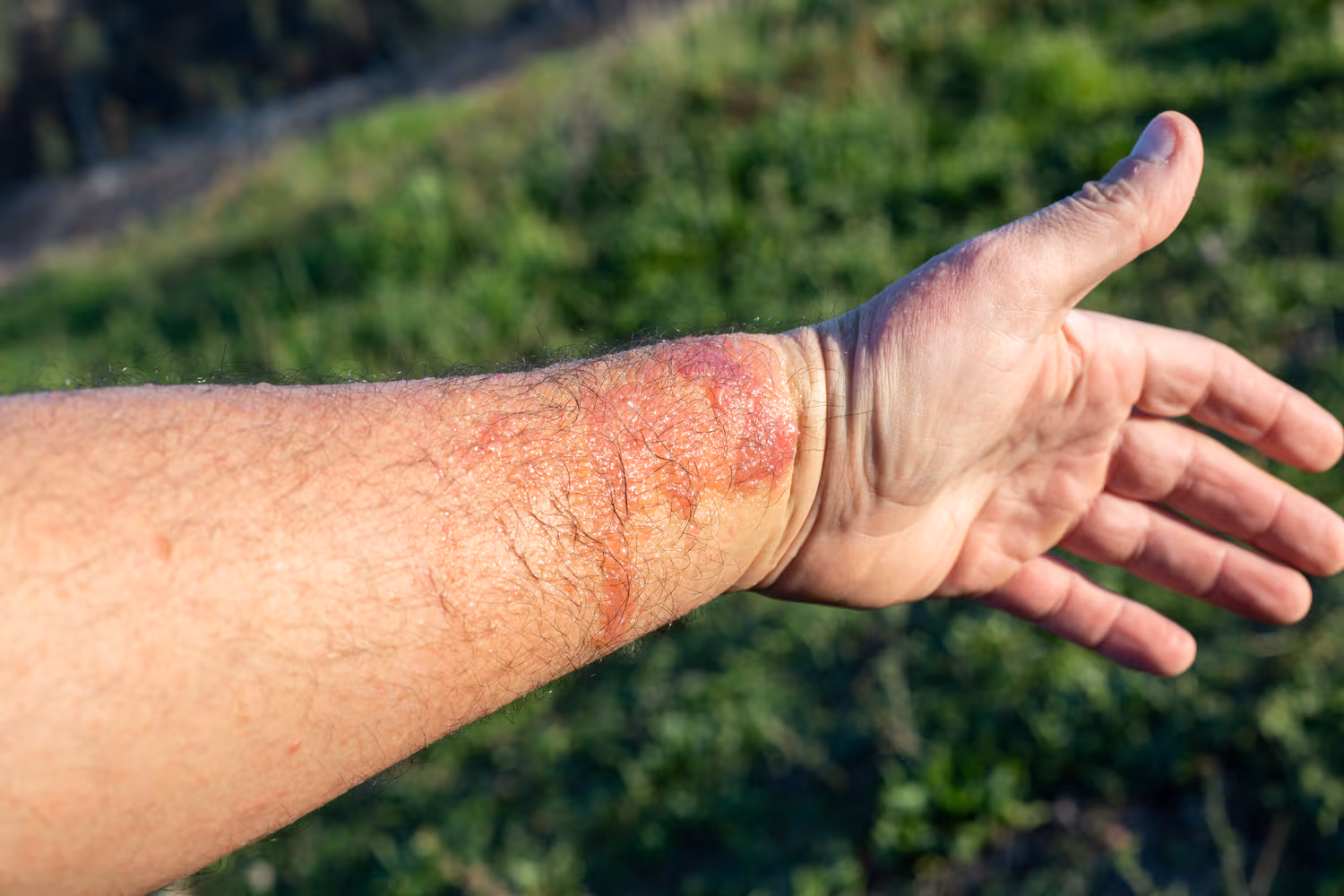 Learn how to treat and prevent rashes and blisters from margarita burn (phytophotodermatitis), a painful skin reaction caused by citrus and sun exposure.